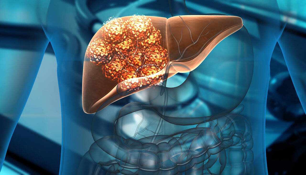 Liver Metastasis An Emerging Treatment Option Cyberknife Miami 7149