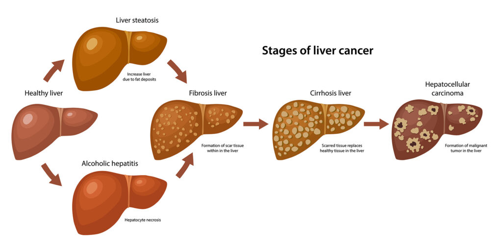 can breast cancer travel to the liver