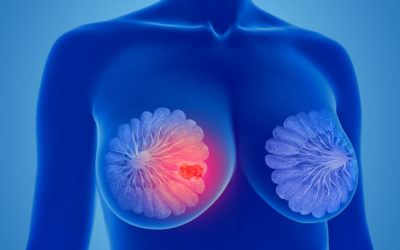 Single-Dose Radiotherapy for Breast Cancer Reduces Damage to Nearby Organs