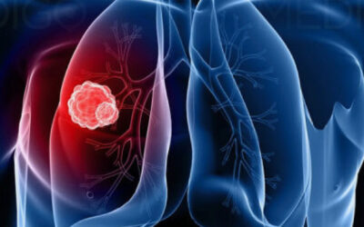 Lung Cancer is Increasing Among Non-Smokers ~ What’s Their Chance of Survival Compared to Smokers & What’s Their Best Treatment Option?