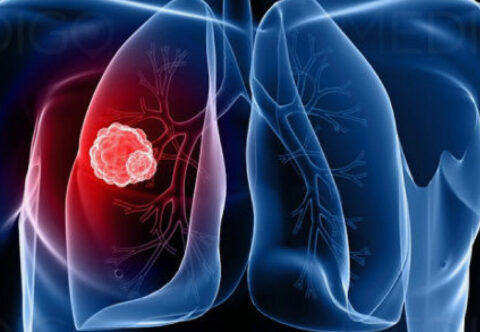 Lung Cancer is Increasing Among Non-Smokers ~ What’s Their Chance of ...