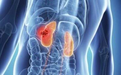 Non-Surgical Kidney Cancer Treatment With CyberKnife Radiation Therapy