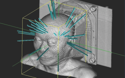 CyberKnife = #1 Treatment For Trigeminal Neuralgia: